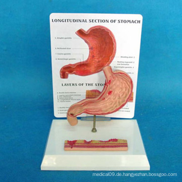 Menschlicher Magen Anatomisches Magengeschwür Medizinisches Demonstrationsmodell (R100208)